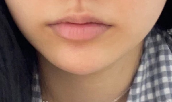 윗입술 필러 할말