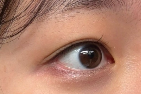 쌍수 할말 골라주세요 ㅜㅜ