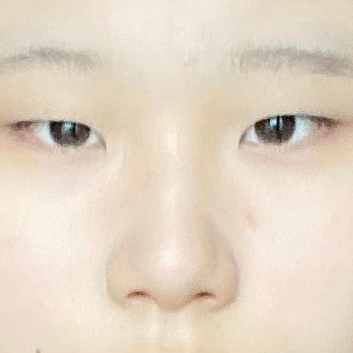 몽고주름 개심한데 앞트임 해야할까?(왼=하셈)