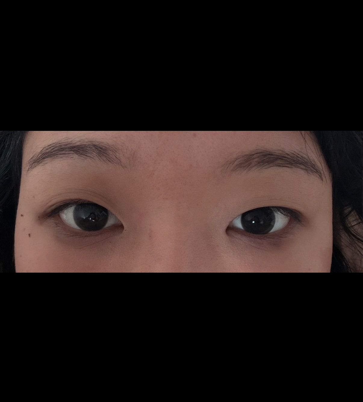 세미아웃 쌍수 어떨까??