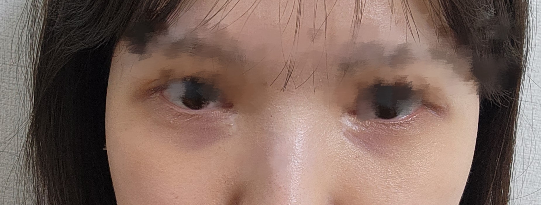 눈 밑 다크서클.. (사진 주의)