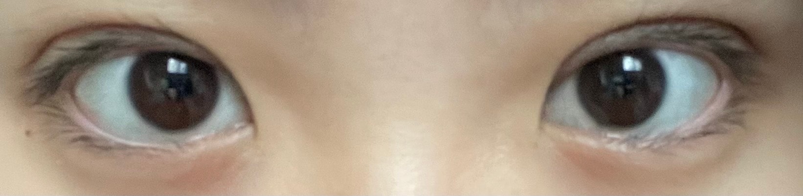 쌍수 2개월찬데 이게맞나.