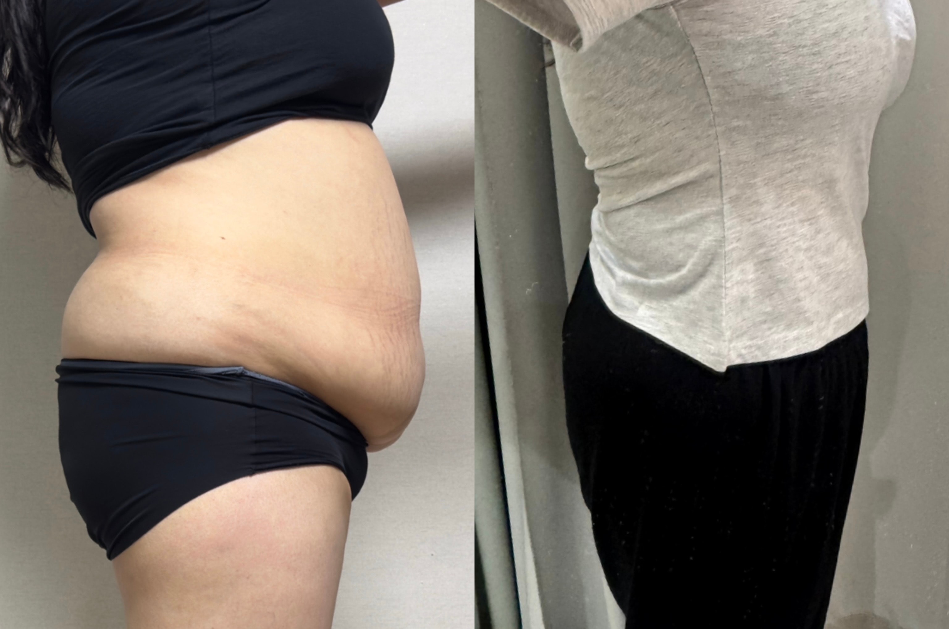 복부지흡 후기 출산전후 아니냐고!!