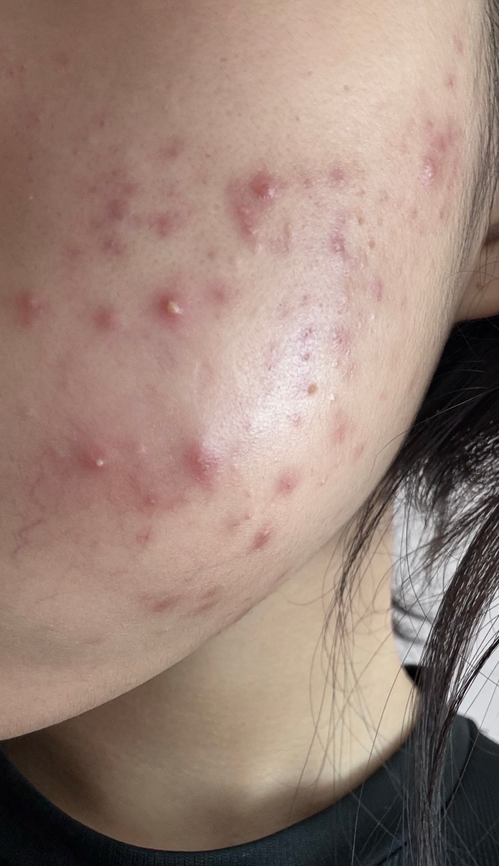 혐오주의) 피부 고민 ㅈ된다