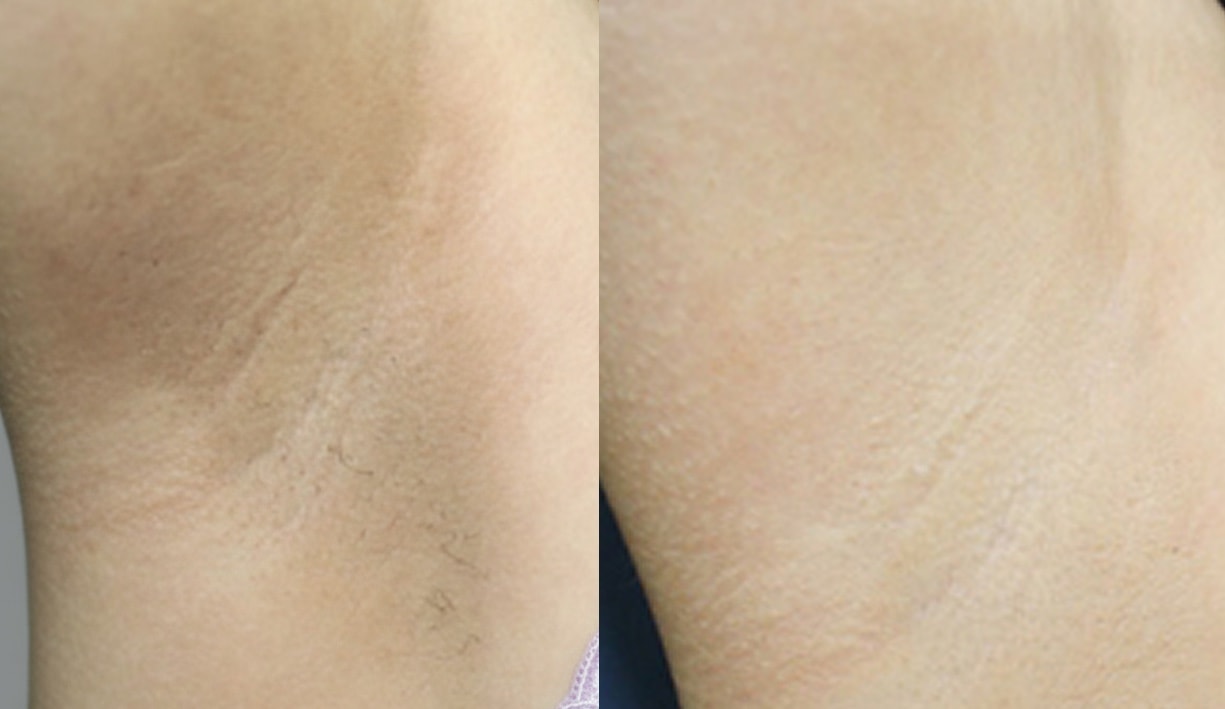 피부과에서도 안알려주는 착색 관리법(사진有)