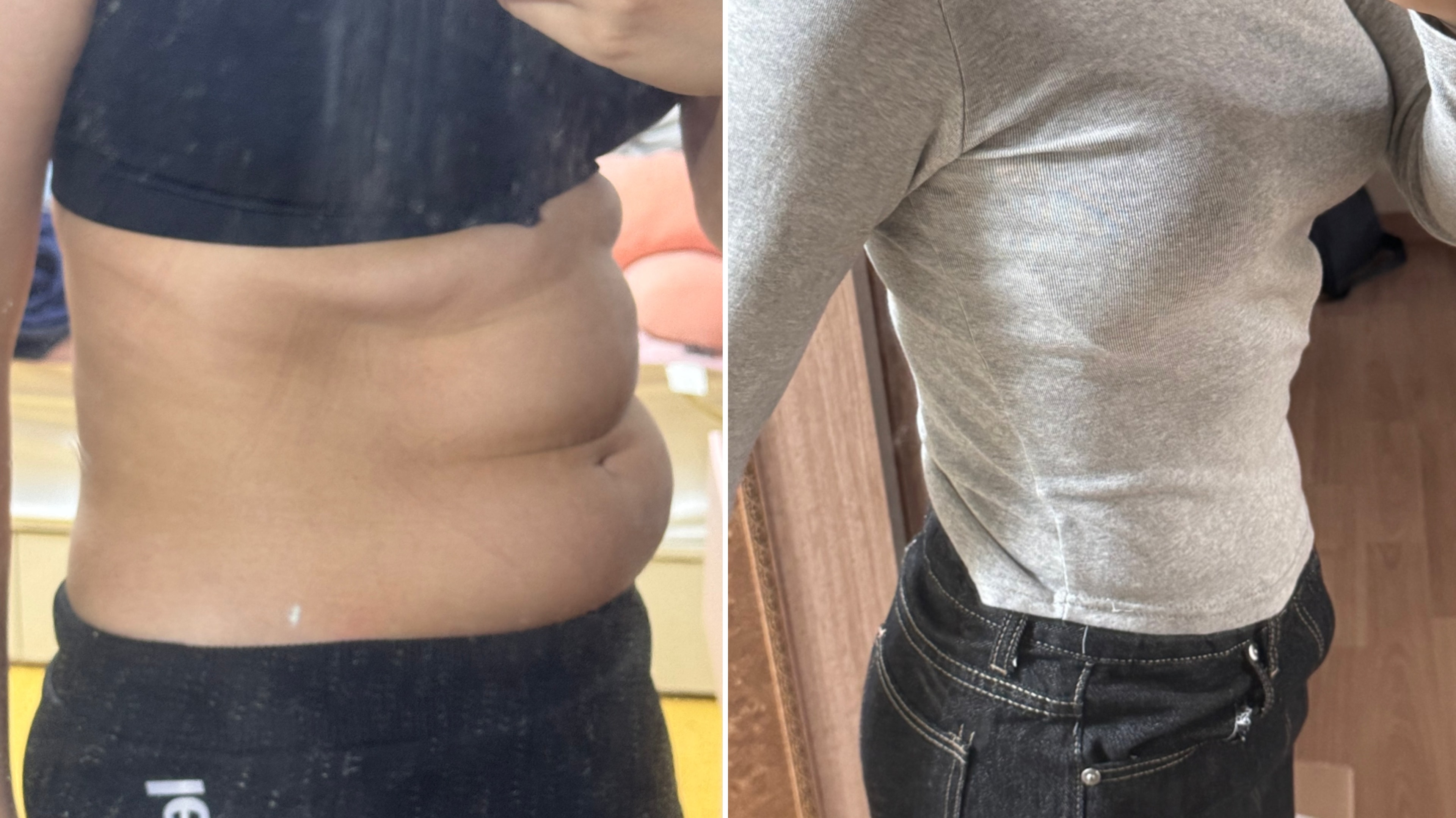 복부주사로 뱃살커팅한 후기(전후사진있음)