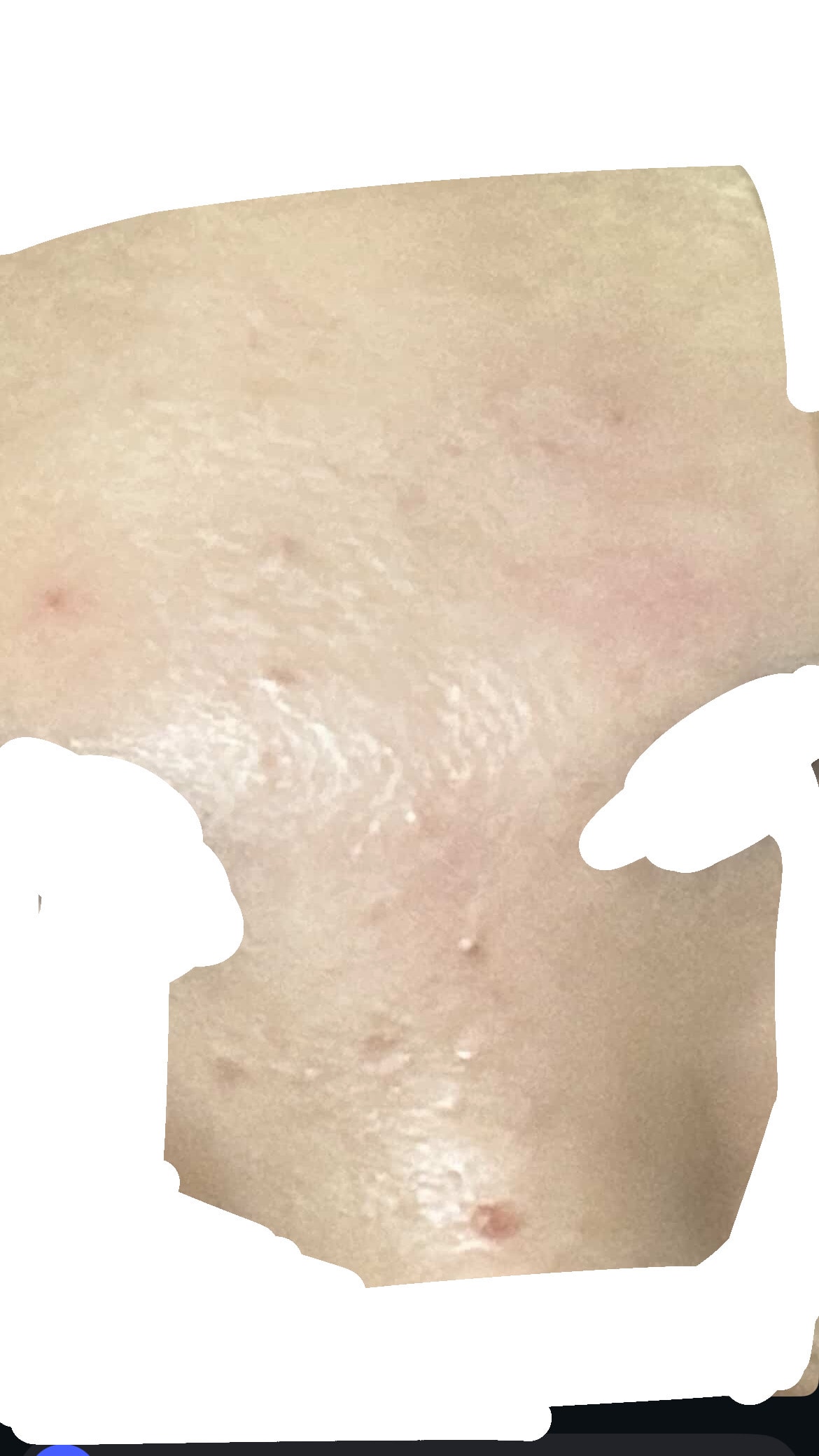 여드름 약 추천해줘 ㅠㅠ