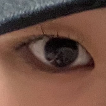 교정(부분교정) vs 쌍수(인라인)