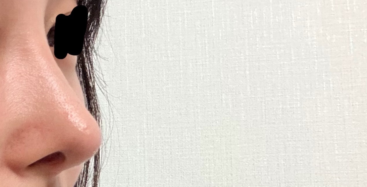 코 수술 한지 5개월째