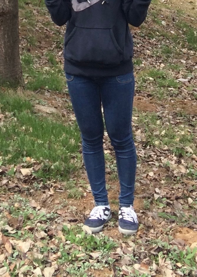 하체 고민 심했던 사람의 지방추출주사 현실 후기