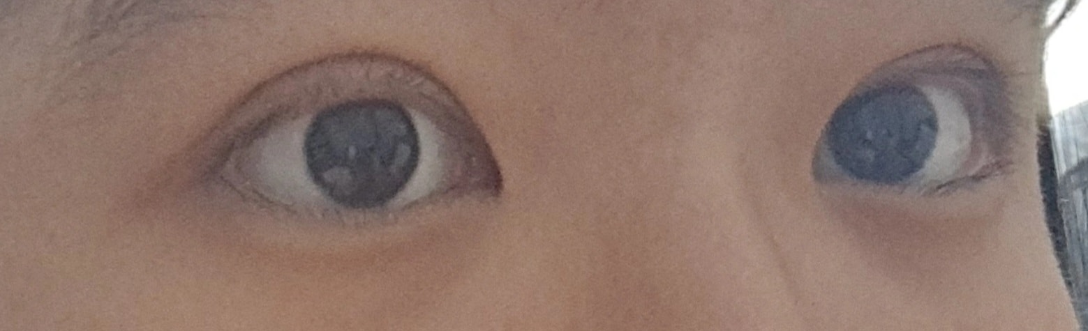 나 쌍수 망한건가