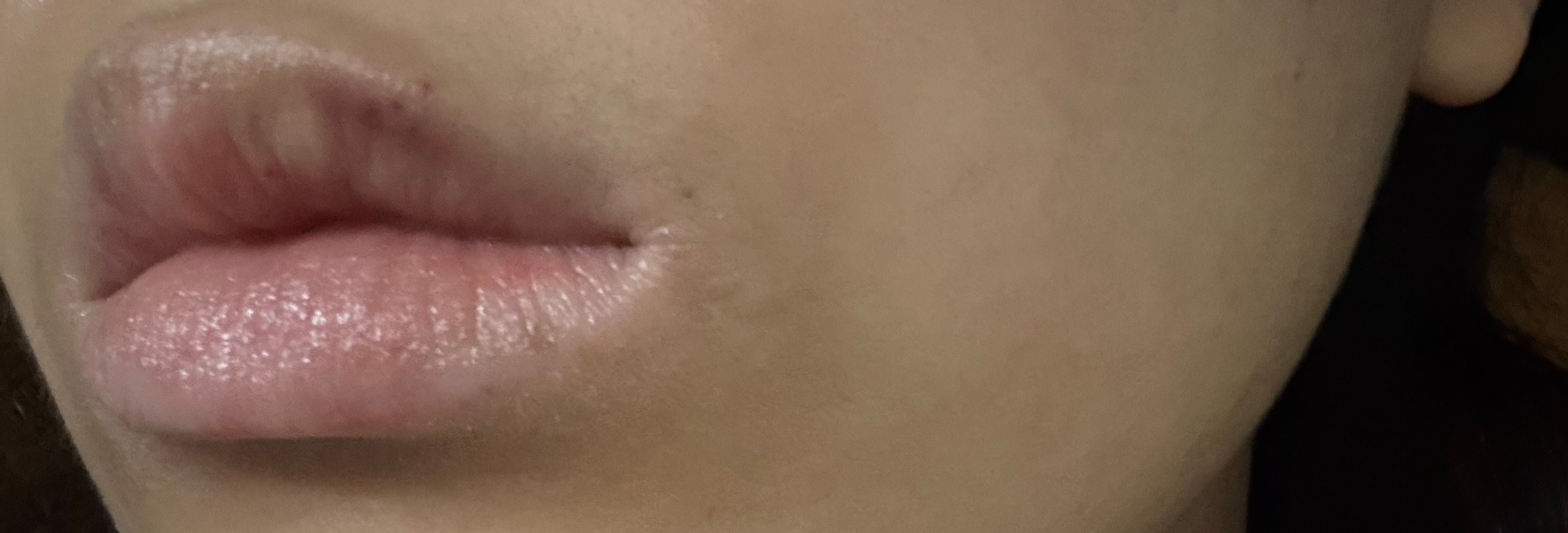 입술필러 잘못된거야??