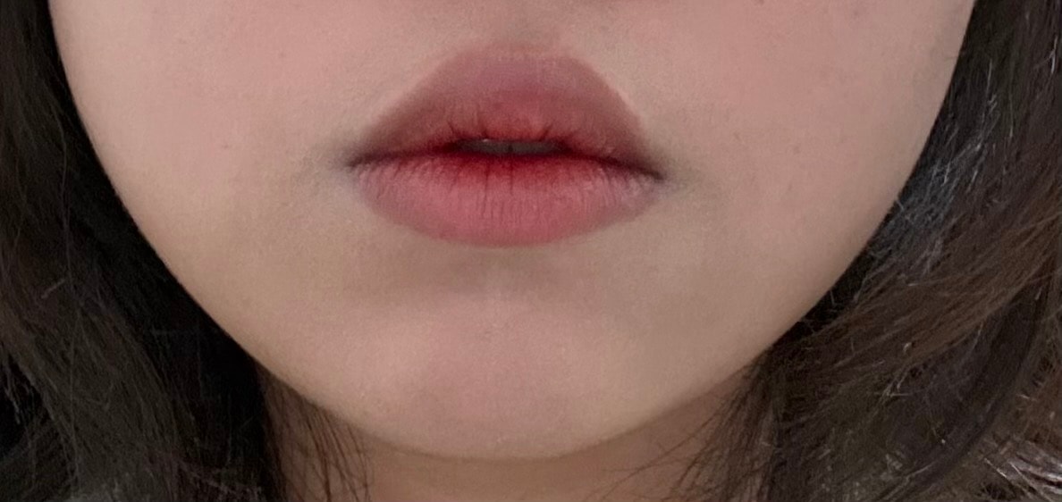 턱 시술 잘 아는 언니!!!!!
