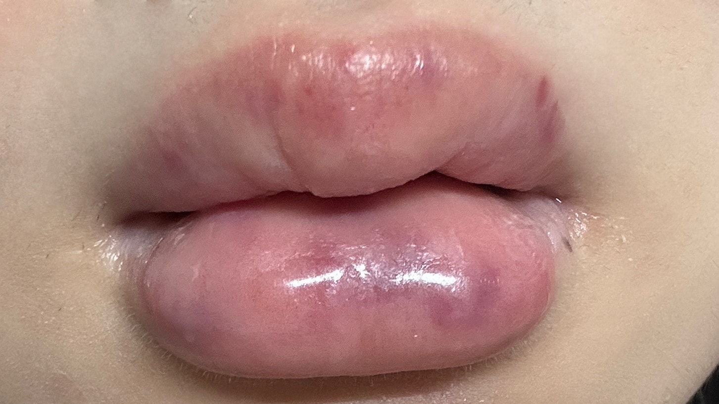 엥 입술필러 이거 맞오?ㅠㅠ