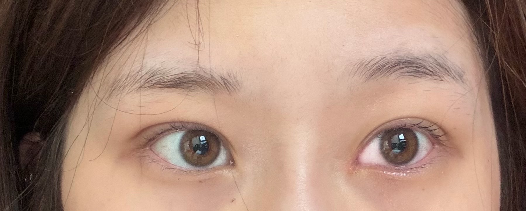 쌍수3주차 붓기좀 봐줘..
