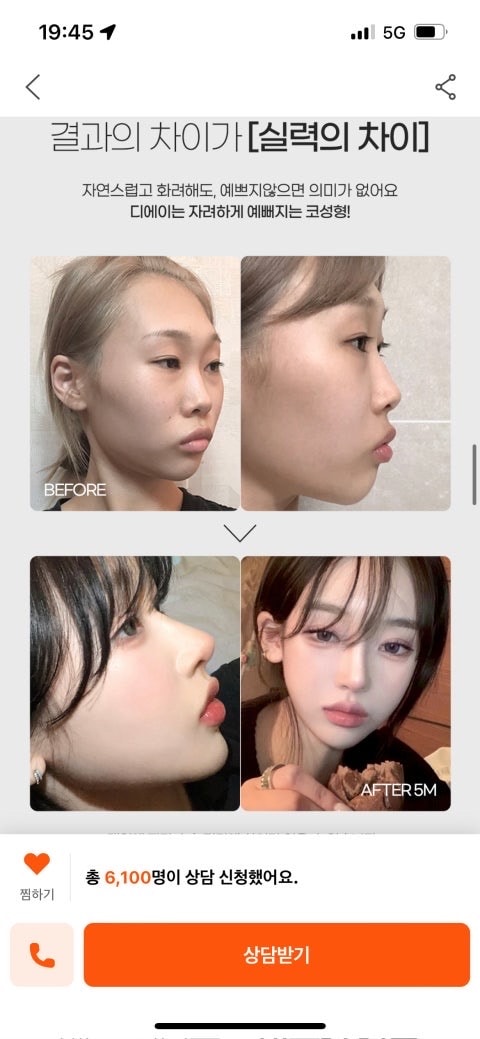 인플루언서 홍주 성형