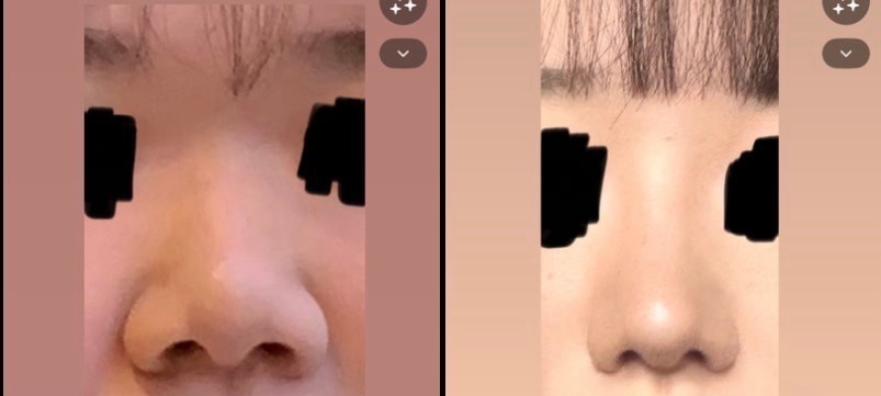 나 코수술 7개월찬데