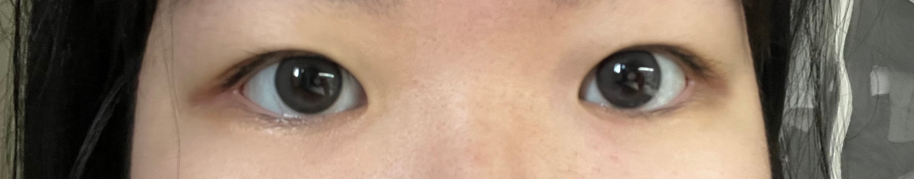 내 눈 앞트임 어떻게 할지 좀 도와줘 ㅠㅠ