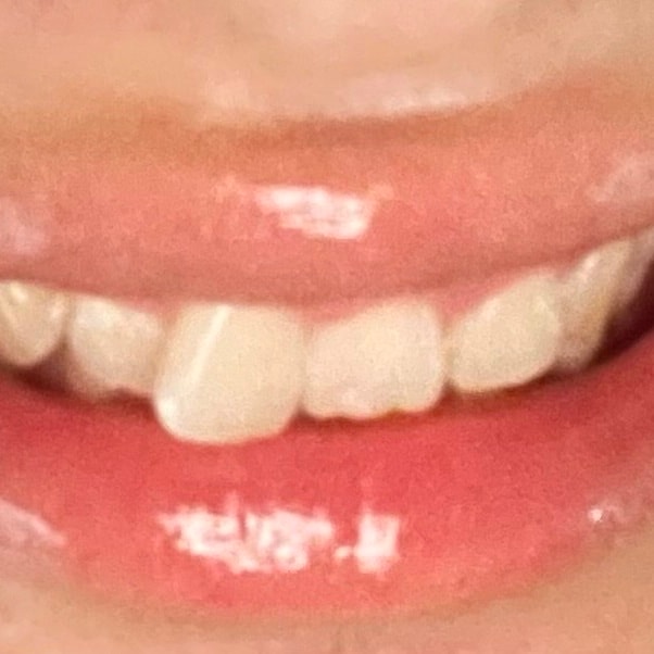 교정(부분교정) vs 쌍수(인라인)