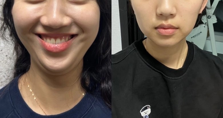 (꿀팁)성형+평소 붓기빼는 정보모음+실험(?)