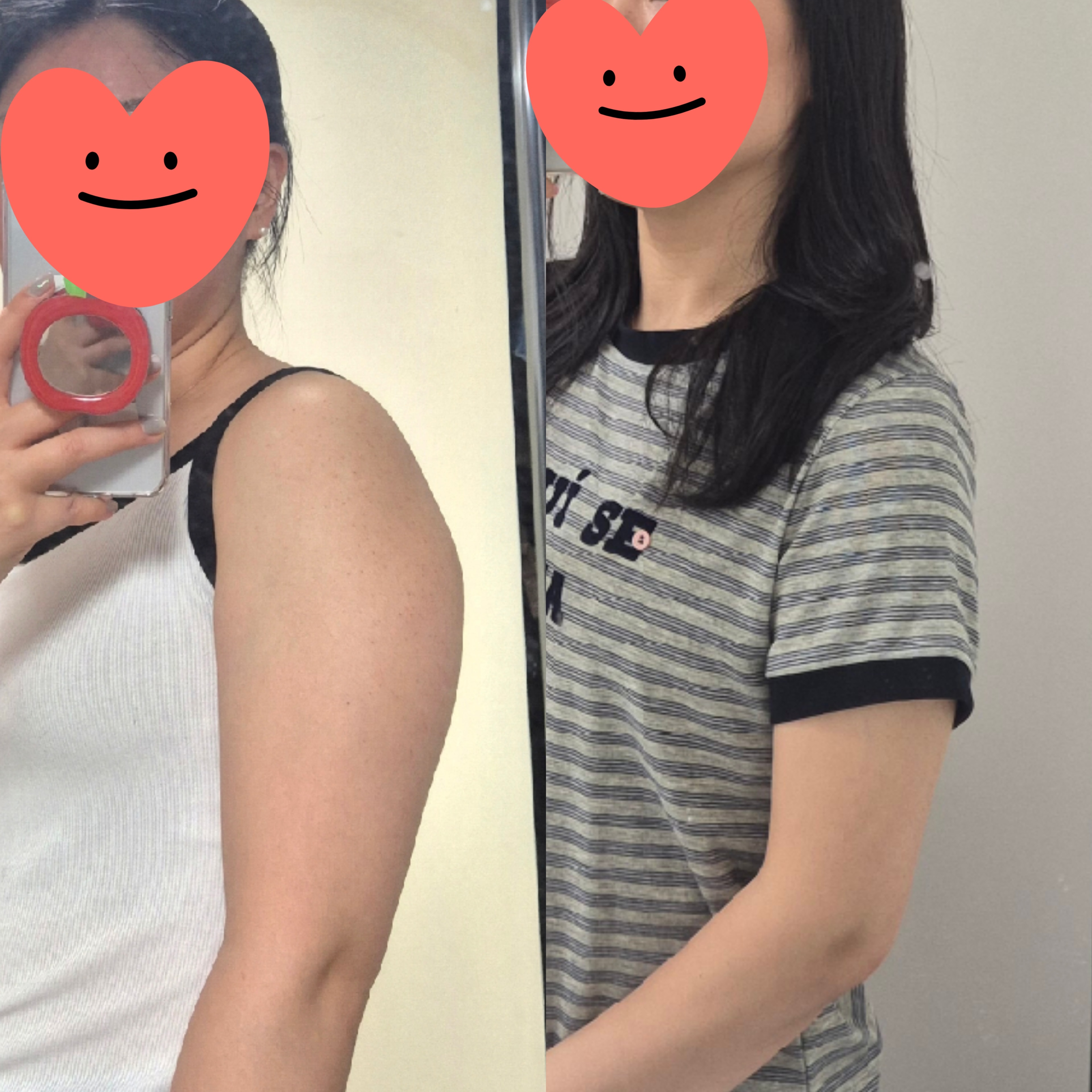 팔 지흡 대성공했는데 허벅지도 하고싶음ㅋㅋ