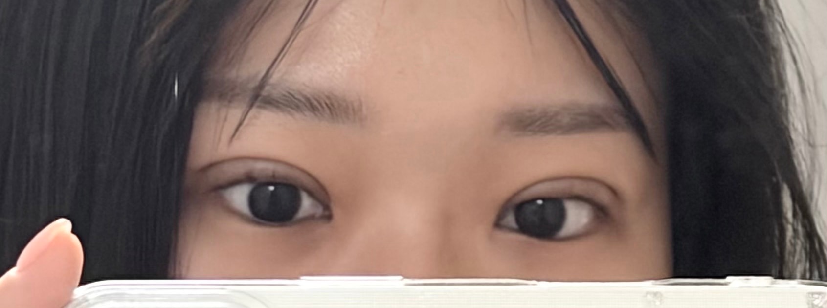 쌍수 20일차 정도 됐는데 붓기 이정도면 정상인거야?
